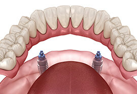 protetica dentara sectorul 4