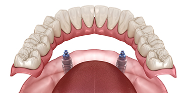 protetica dentara sectorul 4